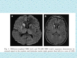 Prion diseases ---kuru | PPTX