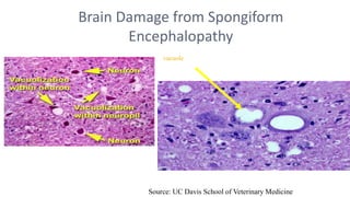 vacuole
Source: UC Davis School of Veterinary Medicine
Brain Damage from Spongiform
Encephalopathy
 