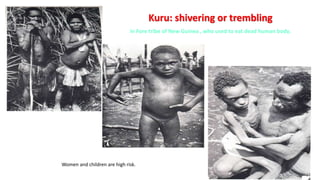 Kuru: shivering or trembling
in Fore tribe of New Guinea , who used to eat dead human body.
Women and children are high risk.
27
 
