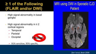 • High signal abnormality in basal
ganglia
• High signal abnormality in ≥ 2
cortical regions
• Temporal
• Parietal
• Occipital
• 91% sensitive, 95% specific,
Frontal
Zerr I et al, Brain 2009
 
