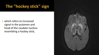  which refers to increased
signal in the putamen and
head of the caudate nucleus
resembling a hockey stick,
 