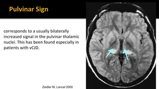 Zeidler M, Lancet 2000
corresponds to a usually bilaterally
increased signal in the pulvinar thalamic
nuclei. This has been found especially in
patients with vCJD.
 