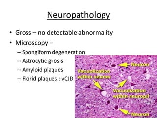 Neuropathology
• Gross – no detectable abnormality
• Microscopy –
– Spongiform degeneration
– Astrocytic gliosis
– Amyloid plaques
– Florid plaques : vCJD
 