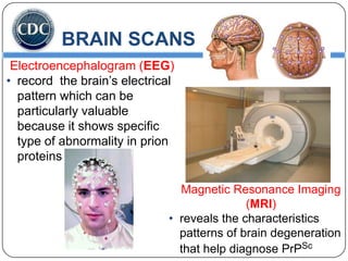 BRAIN SCANS
Electroencephalogram (EEG)
• record the brain’s electrical
pattern which can be
particularly valuable
because it shows specific
type of abnormality in prion
proteins
Magnetic Resonance Imaging
(MRI)
• reveals the characteristics
patterns of brain degeneration
that help diagnose PrPSc

 