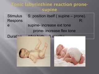 Tonic labyrinthine reaction prone-
supine
Stimulus
Respons
e
S: position itself ( supine – prone).
R:
supine- increase ext tone
prone- increase flex tone
Duration After birth – 3 months.
 