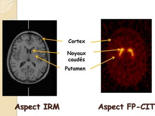 P NP N
Aspect IRM
Cortex
Noyaux
caudés
Putamen
Aspect FP-CIT
 