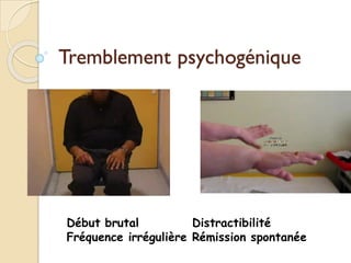Tremblement psychogénique
Début brutal
Fréquence irrégulière
Distractibilité
Rémission spontanée
 