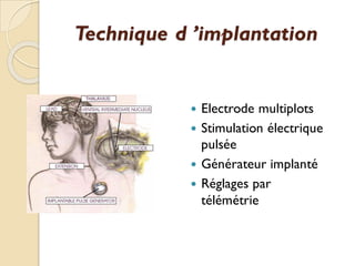 Technique d ’implantation
 Electrode multiplots
 Stimulation électrique
pulsée
 Générateur implanté
 Réglages par
télémétrie
 
