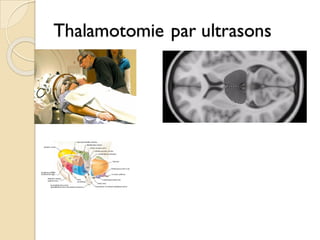 Thalamotomie par ultrasons
 