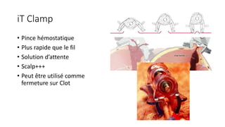 iT Clamp
• Pince hémostatique
• Plus rapide que le fil
• Solution d’attente
• Scalp+++
• Peut être utilisé comme
fermeture sur Clot
 