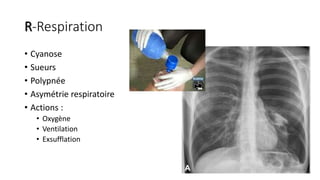 R-Respiration
• Cyanose
• Sueurs
• Polypnée
• Asymétrie respiratoire
• Actions :
• Oxygène
• Ventilation
• Exsufflation
 