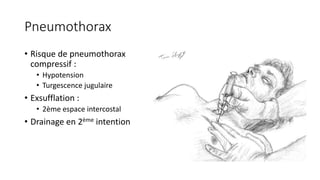 Pneumothorax
• Risque de pneumothorax
compressif :
• Hypotension
• Turgescence jugulaire
• Exsufflation :
• 2ème espace intercostal
• Drainage en 2ème intention
 