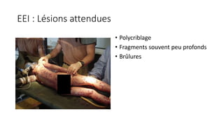 EEI : Lésions attendues
• Polycriblage
• Fragments souvent peu profonds
• Brûlures
 