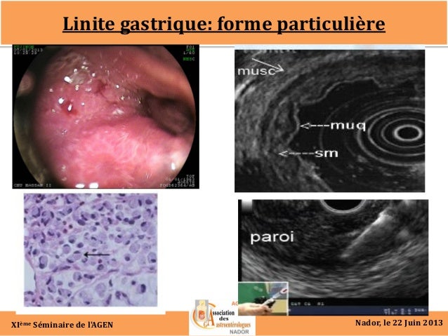 Linite gastrique symptomes