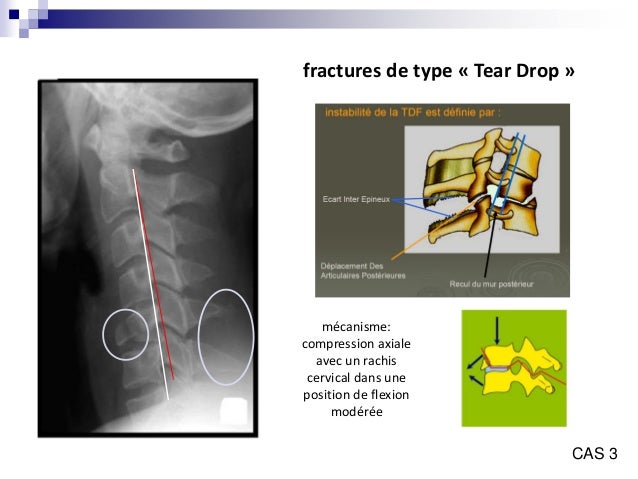 Fracture du rachis cervical pdf