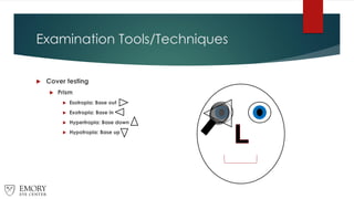 Examination Tools/Techniques
 Cover testing
 Prism
 Esotropia: Base out
 Exotropia: Base in
 Hypertropia: Base down
 Hypotropia: Base up
 