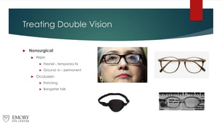 Treating Double Vision
 Nonsurgical
 Prism
 Fresnel – temporary fix
 Ground- in – permanent
 Occlusion
 Patching
 Bangarter foils
 