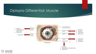 Diplopia Differential: Muscle
1. Elevation
2. Intorsion
3. Adduction
1. Adduction
1. Depression
2. Extorsion
3. Adduction
1. Extorsion
2. Depression (on abduction)
3. Abduction
1. Abduction
1. Intorsion
2. Depression (on
adduction)
3. Abduction
 