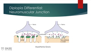Diplopia Differential:
Neuromuscular Junction
Myasthenia Gravis
 