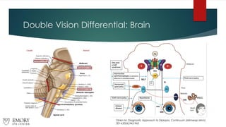 Double Vision Differential: Brain
Dinkin M. Diagnostic Approach to Diplopia. Continuum (Minneap Minn)
2014;20(4):942-965
 