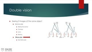 Double vision
 Seeing 2 images of the same object
 Monocular
 Refractive error
 Cornea
 Lens
 Retina
 Binocular
 Not bifoveal
 