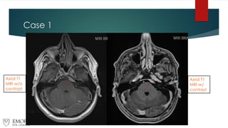 Case 1
Axial T1
MRI w/o
contrast
Axial T1
MRI w/
contrast
 