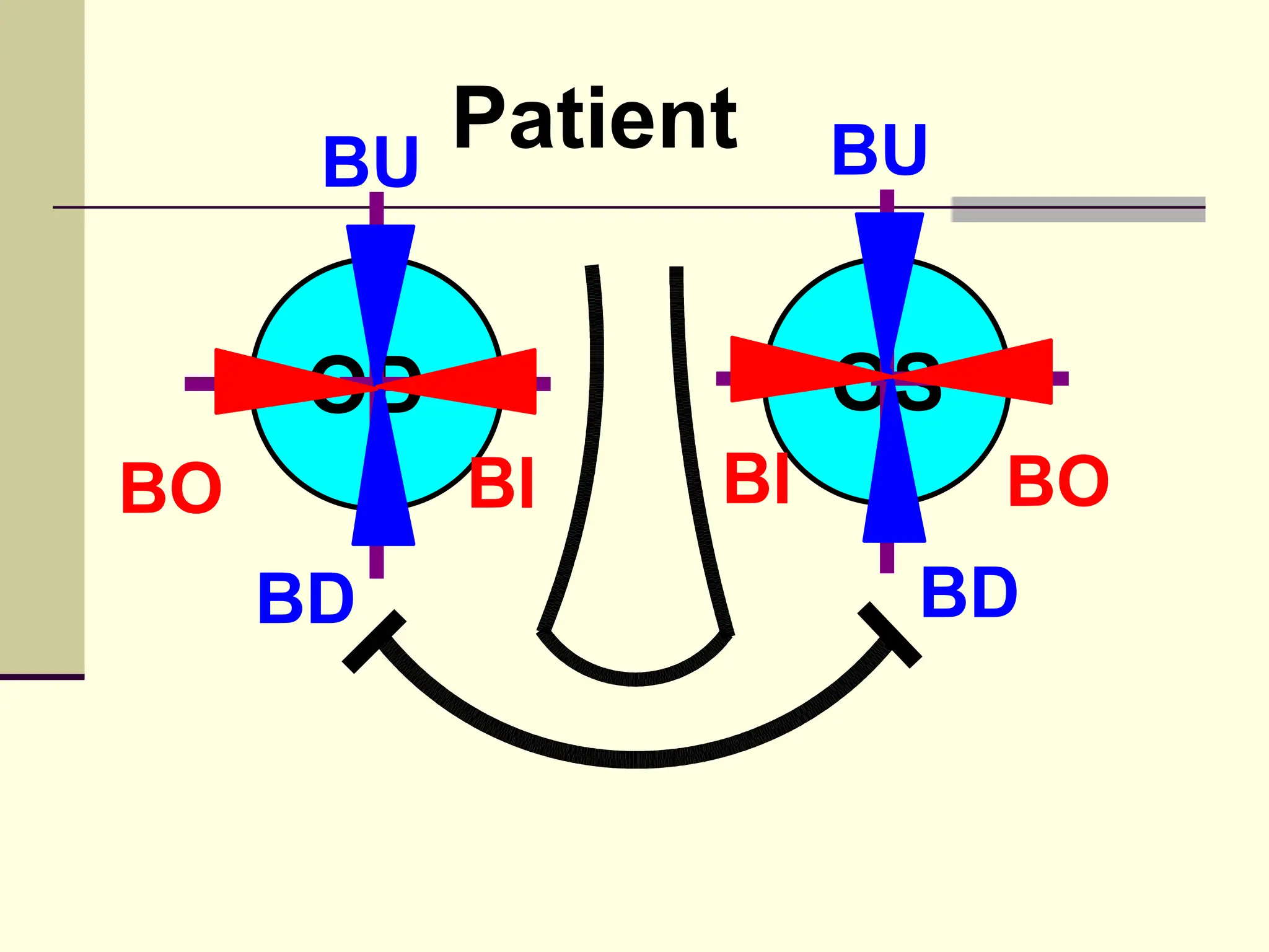 BU
         Patient     BU


      OD             OS
BO         BI   BI        BO
     BD               BD
 