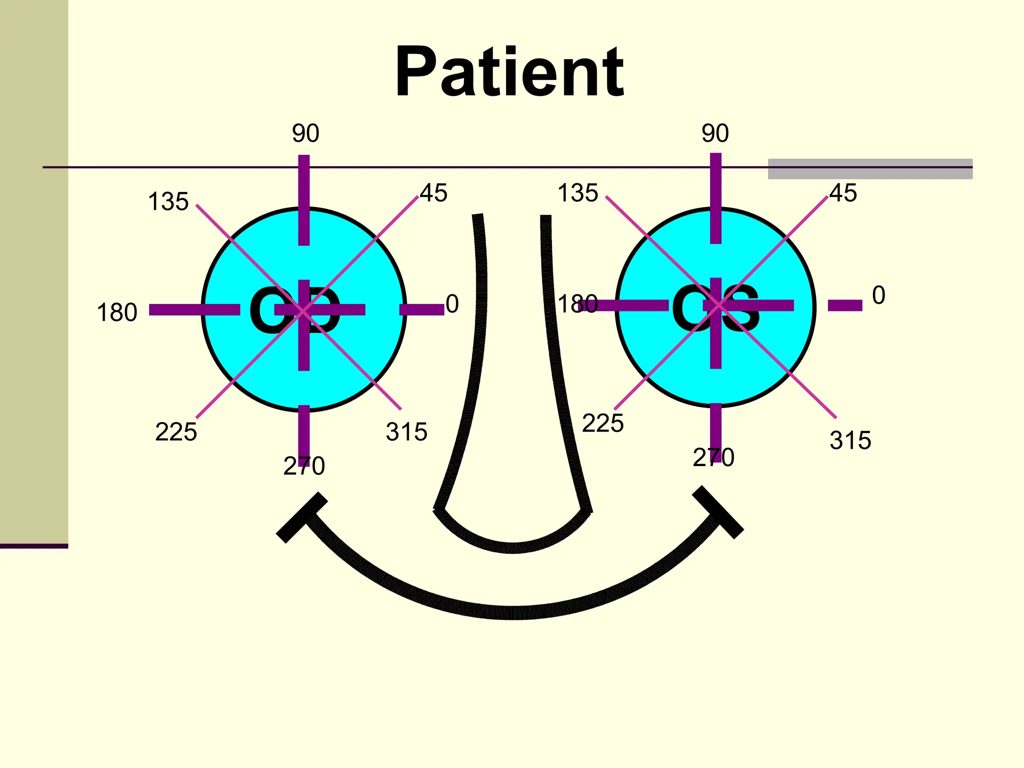Patient
            90                     90

      135           45      135          45



180         OD          0   180
                                   OS         0




      225         315        225
                                         315
            270                    270
 