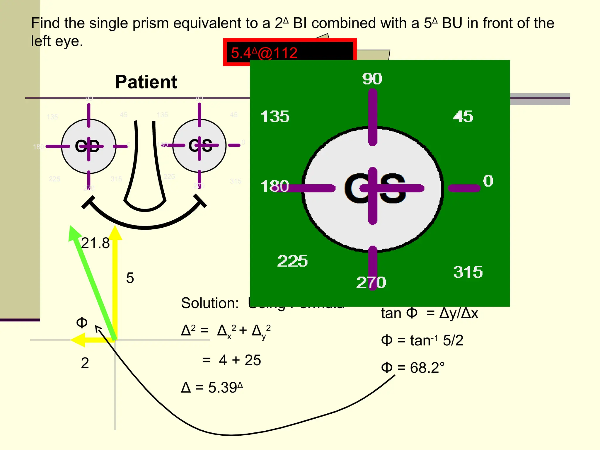 Find the single prism equivalent to a 2Δ BI combined with a 5Δ BU in front of the
left eye.
                              5.4Δ@112
                                                   5
                    Patient
            90                        90

      135            45      135           45



180         OD           0   180
                                     OS          0




      225          315        225
                                           315
            270                      270
                                                     2


            21.8

                         5
                                    Solution: Using Formula –
                                                                tan Φ = Δy/Δx
            Φ                       Δ2 = Δx2 + Δy2
                                                                Φ = tan-1 5/2
            2                          = 4 + 25
                                                                Φ = 68.2°
                                    Δ = 5.39Δ
 