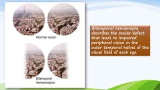 Bitemporal hemianopia
describes the ocular defect
that leads to impaired
peripheral vision in the
outer temporal halves of the
visual field of each eye.
 