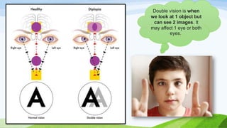 Double vision is when
we look at 1 object but
can see 2 images. It
may affect 1 eye or both
eyes.
 