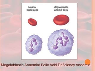 Megaloblastic Anaemia/ Folic Acid Deficiency Anaemia
 