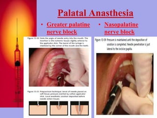Palatal Anasthesia 
• Greater palatine 
nerve block 
• Nasopalatine 
nerve block 
77 
 