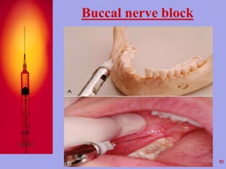 Buccal nerve block 
80 
 