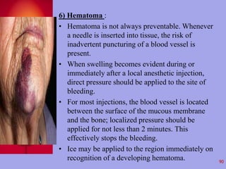 6) Hematoma : 
• Hematoma is not always preventable. Whenever 
a needle is inserted into tissue, the risk of 
inadvertent ...