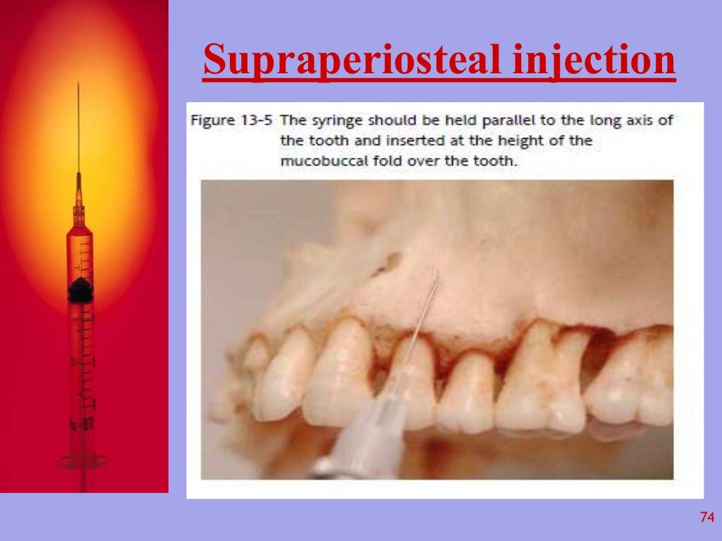 Local Anesthesia in Dentistry