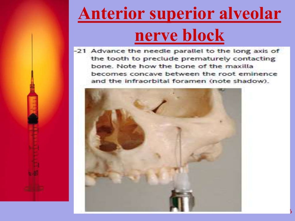 Local Anesthesia in Dentistry