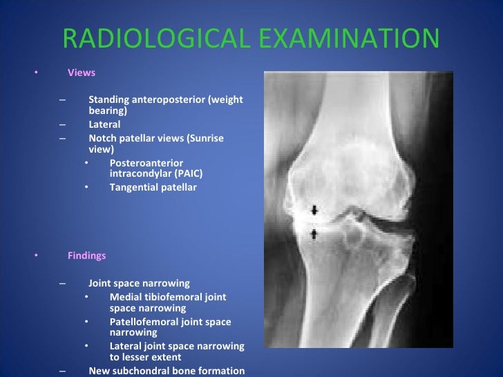 osteoarthritis knee priyank