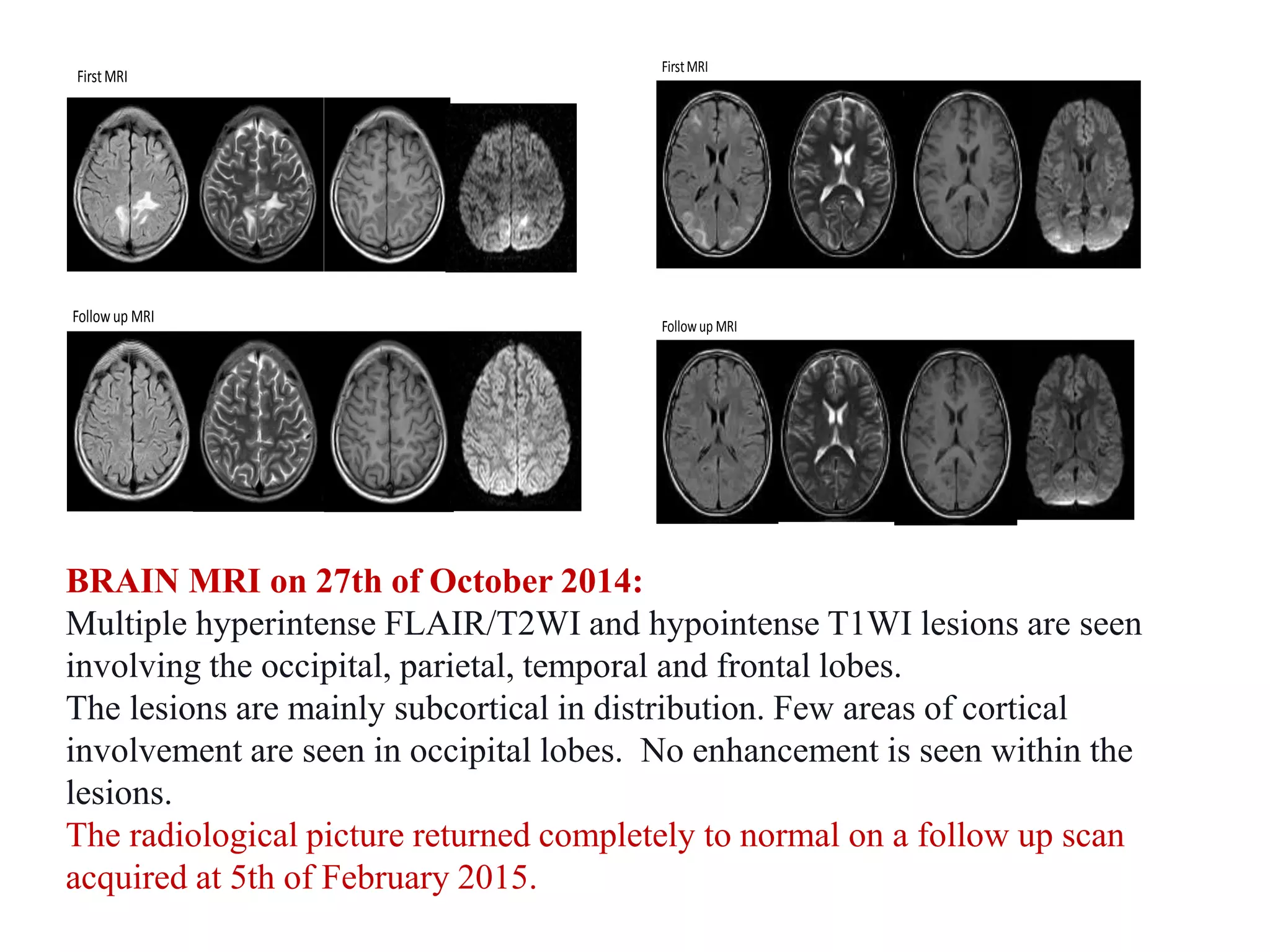 FirstMRI
Followup MRI
FirstMRI
Followup MRI
BRAIN MRI on 27th of October 2014:
Multiple hyperintense FLAIR/T2WI and hypointense T1WI lesions are seen
involving the occipital, parietal, temporal and frontal lobes.
The lesions are mainly subcortical in distribution. Few areas of cortical
involvement are seen in occipital lobes. No enhancement is seen within the
lesions.
The radiological picture returned completely to normal on a follow up scan
acquired at 5th of February 2015.
 