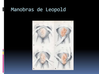 Manobras de Leopold
 