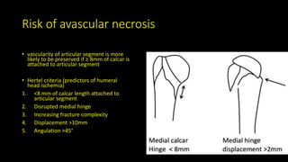 Risk of avascular necrosis
• vascularity of articular segment is more
likely to be preserved if ≥ 8mm of calcar is
attached to articular segment
• Hertel criteria (predictors of humeral
head ischemia)
1. <8 mm of calcar length attached to
articular segment
2. Disrupted medial hinge
3. Increasing fracture complexity
4. Displacement >10mm
5. Angulation >45°
 