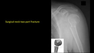Surgical neck two part fracture
 