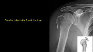Greater tuberosity 2 part fracture
 