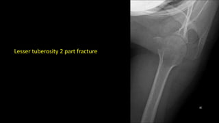 Lesser tuberosity 2 part fracture
 