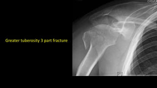 Greater tuberosity 3 part fracture
 