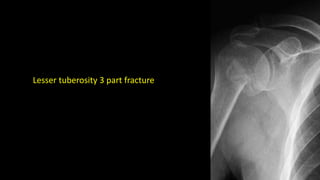 Lesser tuberosity 3 part fracture
 