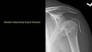 Greater tuberosity 4 part fracture
 