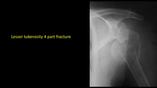 Lesser tuberosity 4 part fracture
 