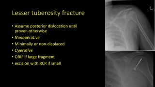 Lesser tuberosity fracture
• Assume posterior dislocation until
proven otherwise
• Nonoperative
• Minimally or non-displaced
• Operative
• ORIF if large fragment
• excision with RCR if small
 