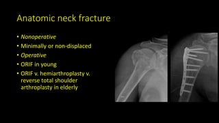 Anatomic neck fracture
• Nonoperative
• Minimally or non-displaced
• Operative
• ORIF in young
• ORIF v. hemiarthroplasty v.
reverse total shoulder
arthroplasty in elderly
 